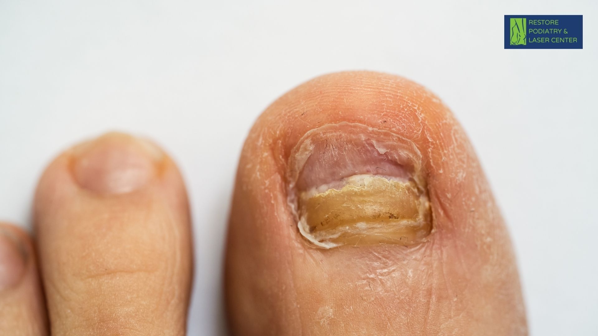 Nail Psoriasis