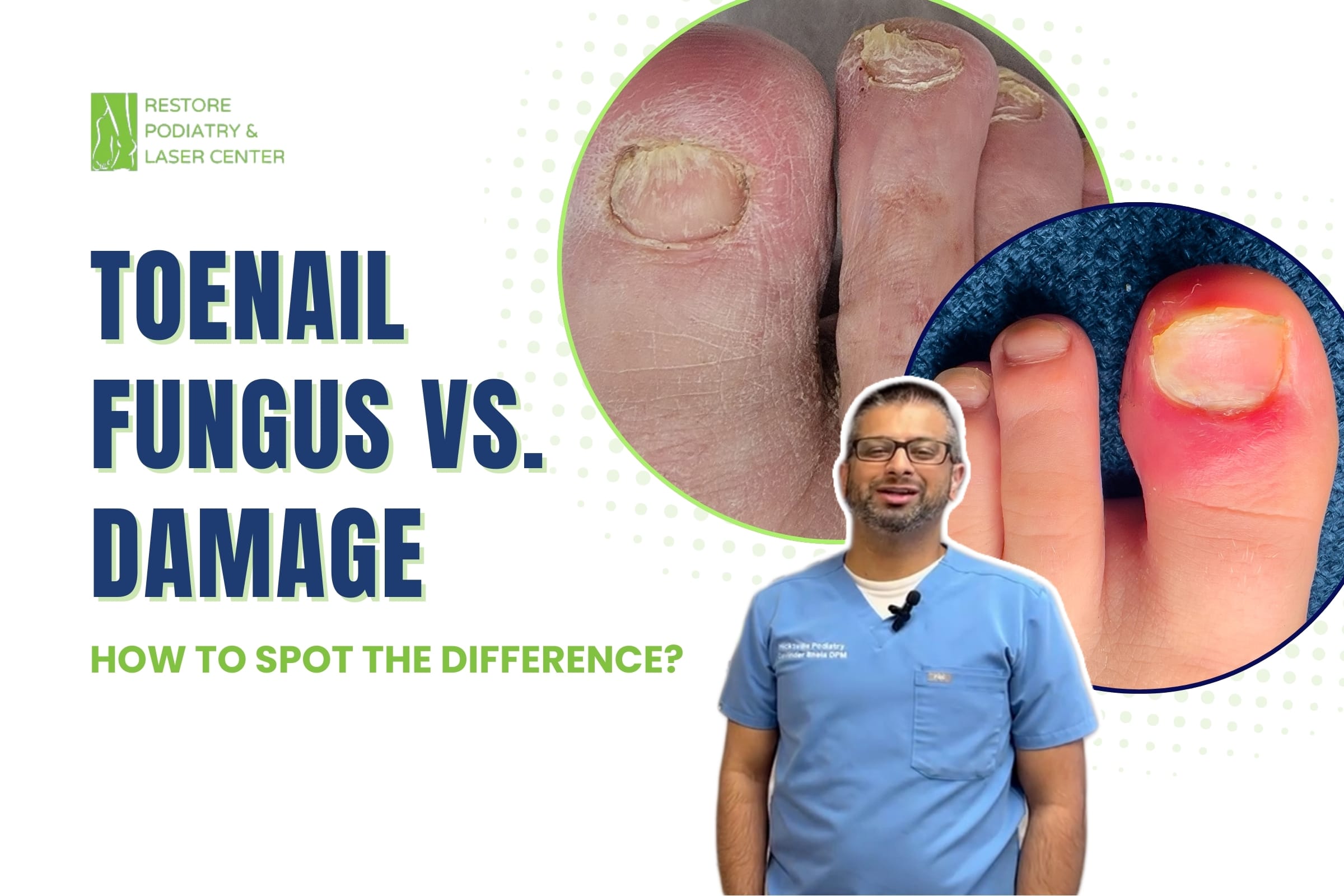 Toenail Fungus vs. Damage How to Spot the Difference