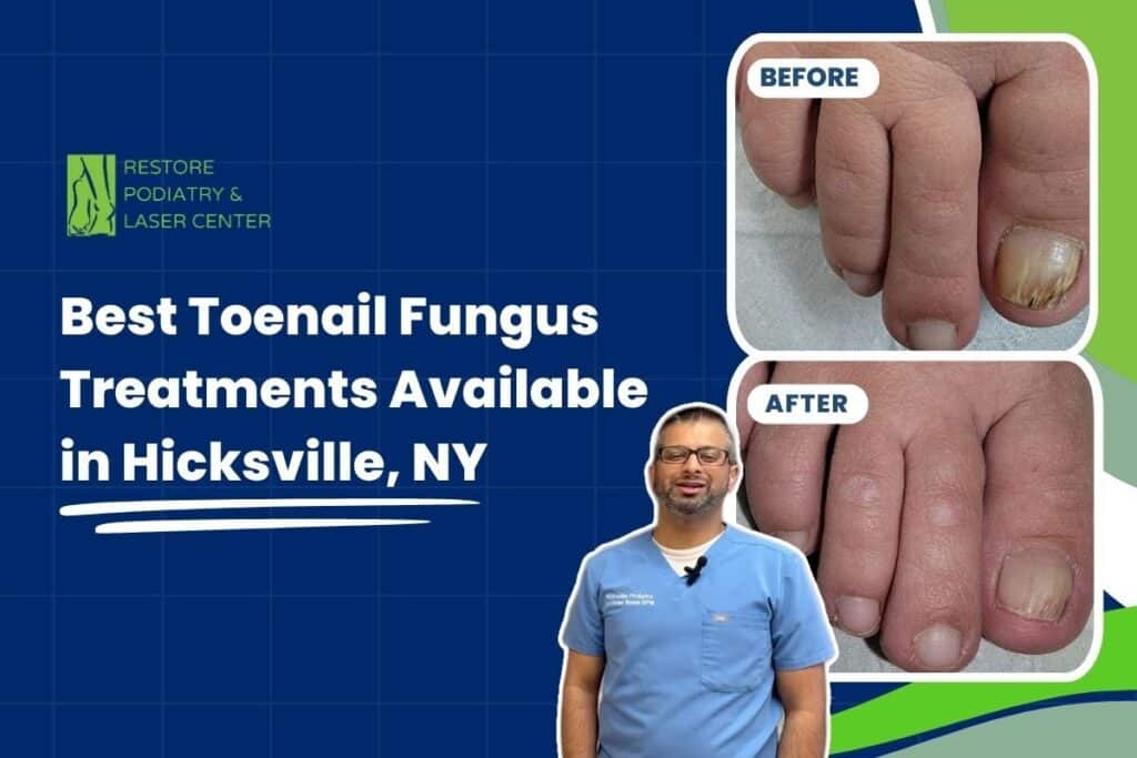 Best Toenail Fungus Treatments Available in Hicksville, NY