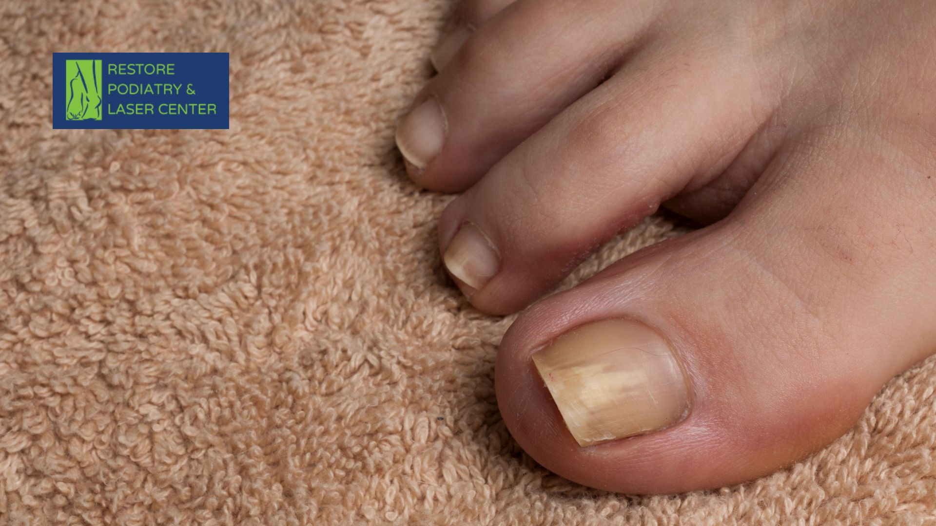 Toenail Fungus Is Common—But It’s Preventable