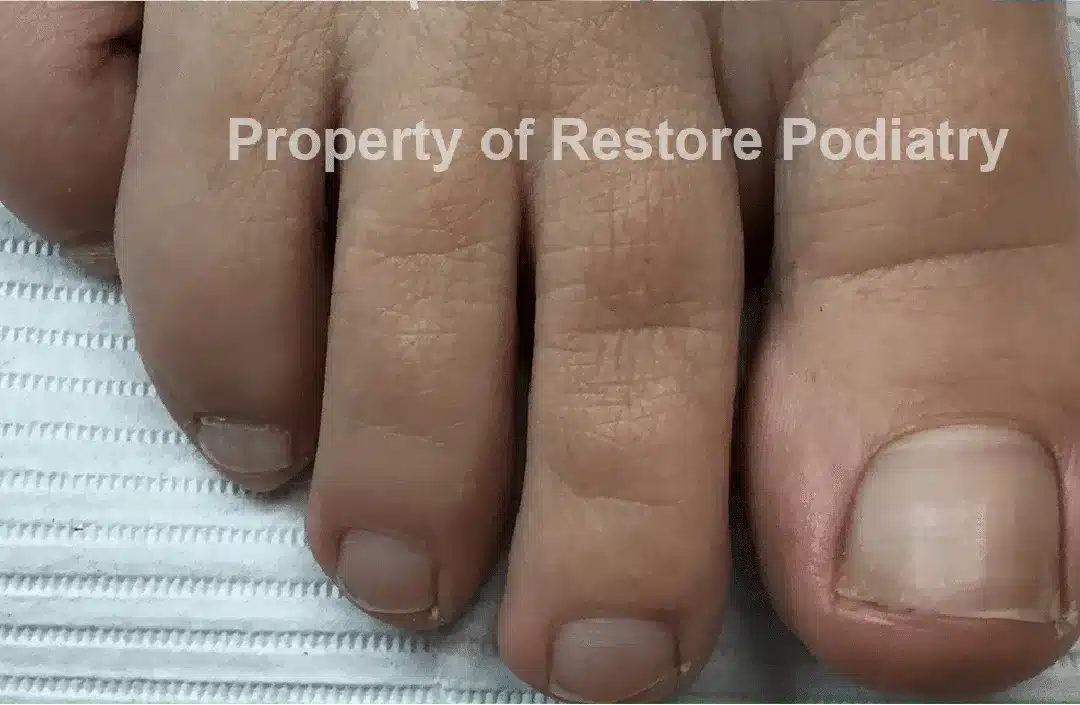 Case-2-After-Toenail Fungus
