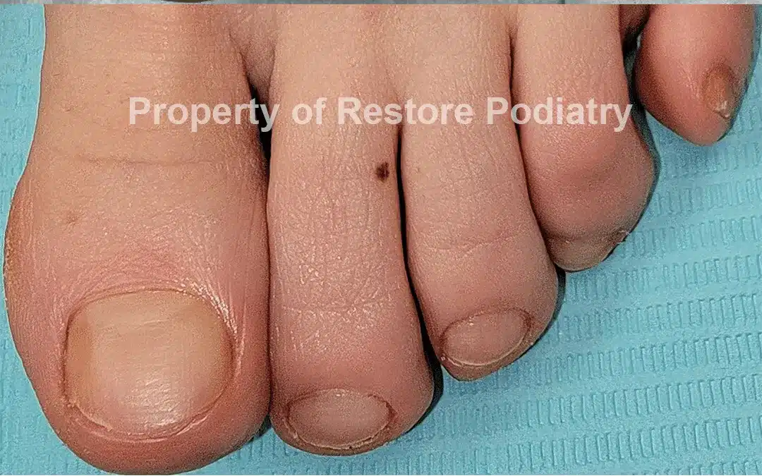 Case-3-After-Toenail Fungus