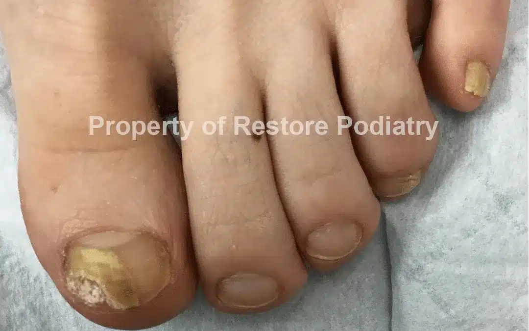 Case-3-Before-Toenail Fungus