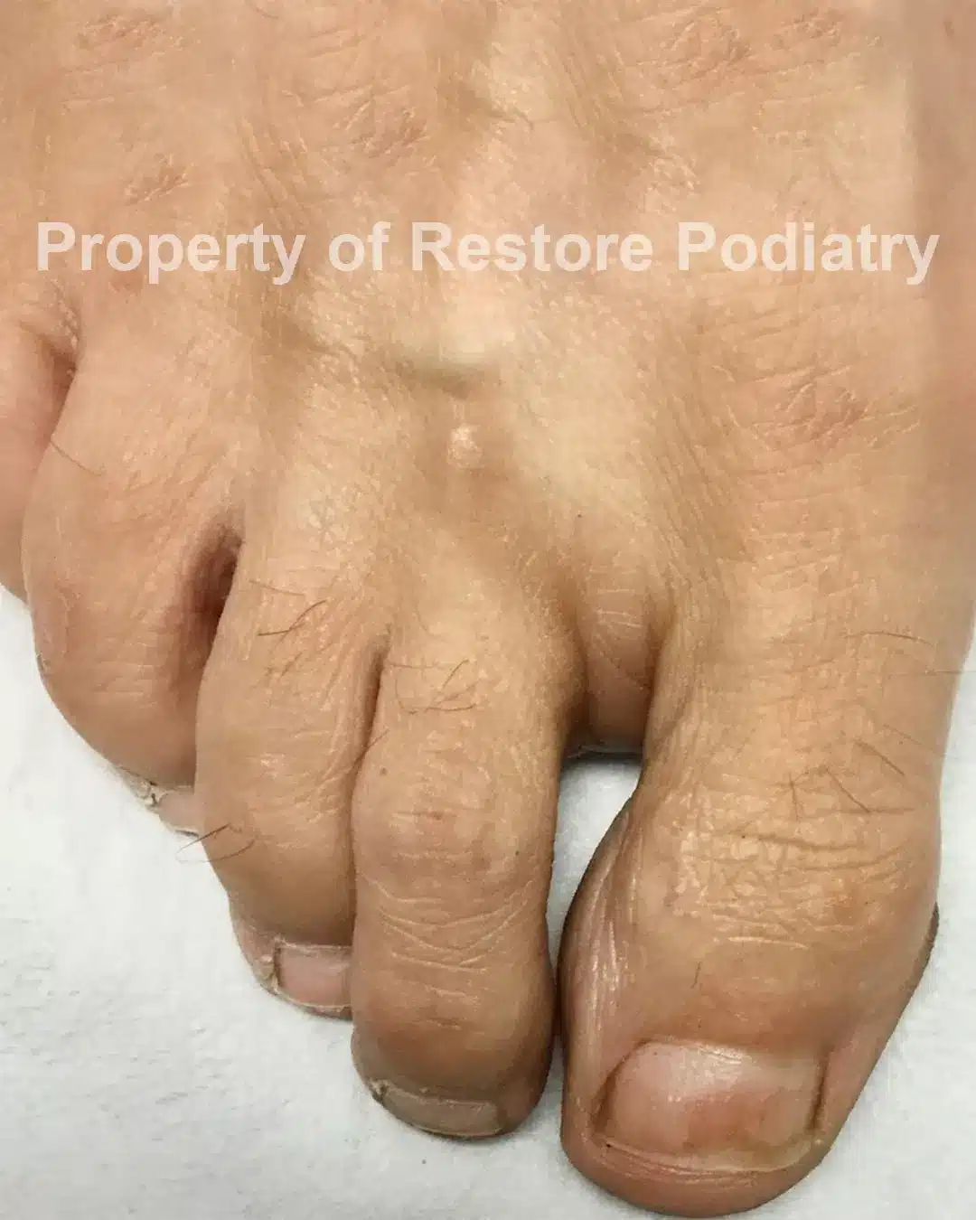 Case-4-after-Toenail Fungus