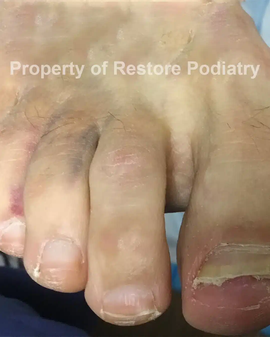 Case-4-before-Toenail Fungus