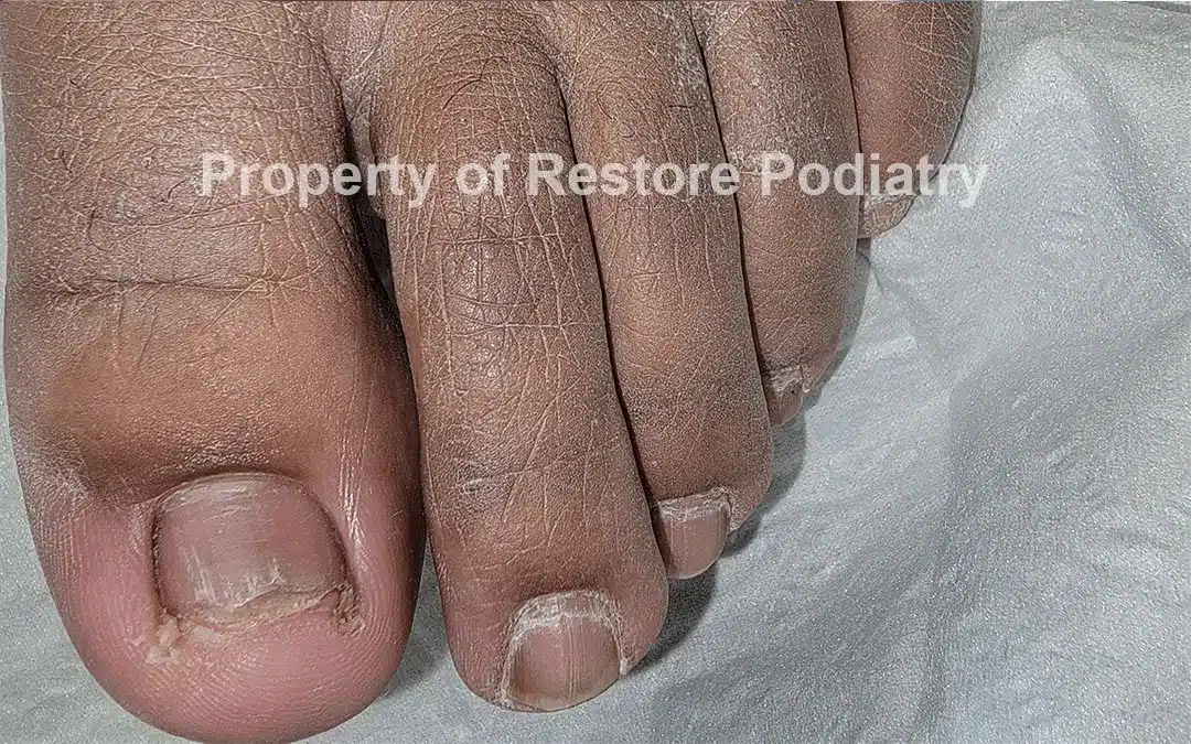 Case-5-After-Toenail Fungus