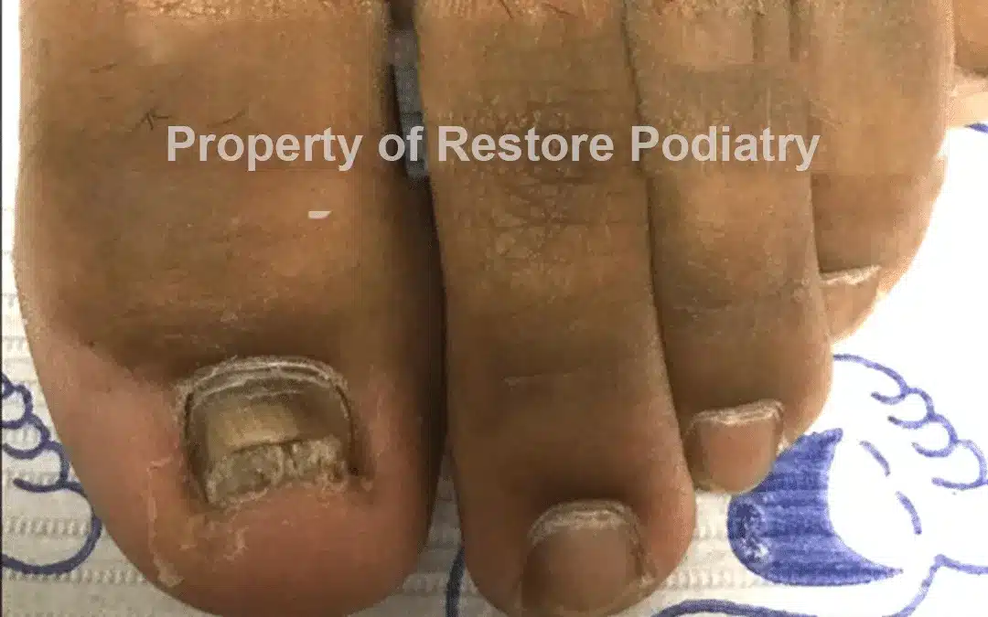 Case-5-Before-Toenail Fungus
