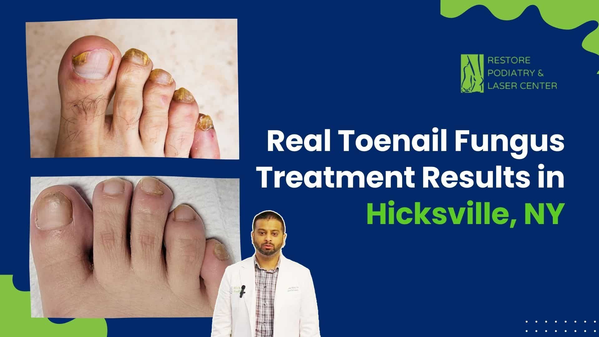 Toenail Fungus Treatment Results in NY