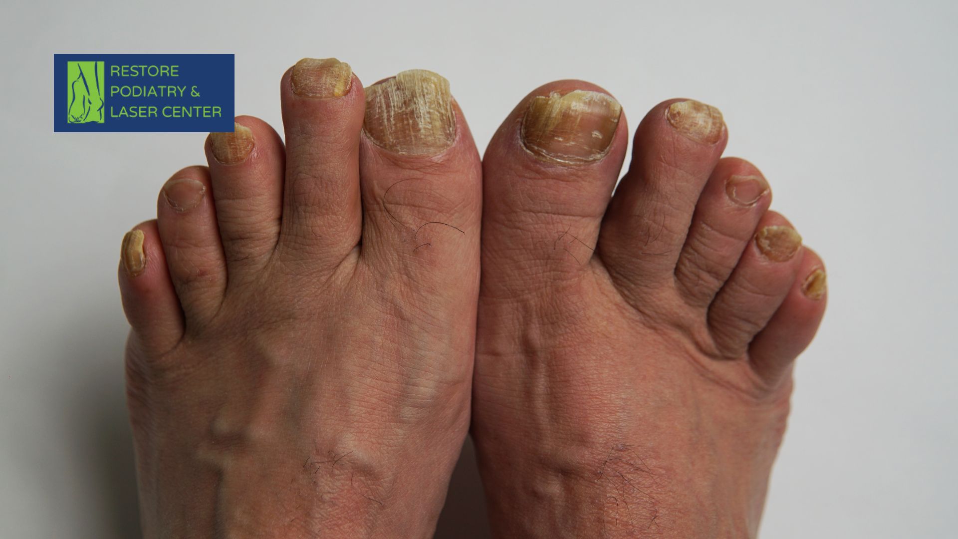 Toenail Fungus in Adults