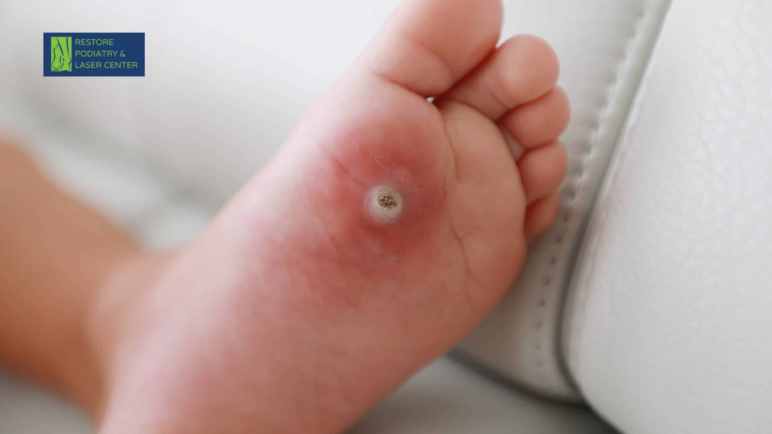 Clear Wart Program™ for Stubborn Plantar Warts