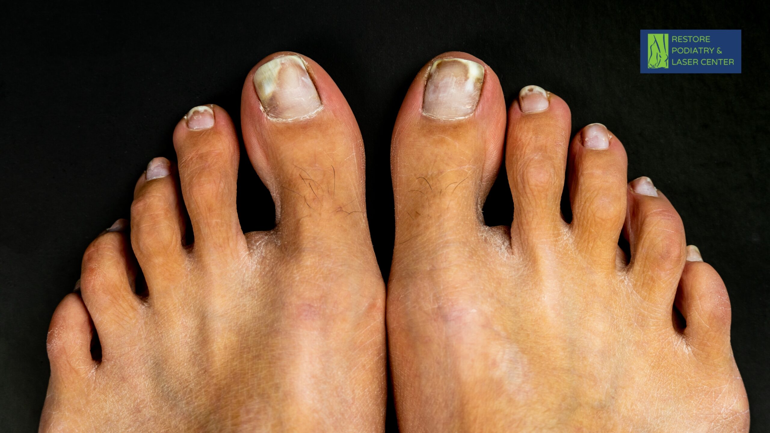 Toenail Fungus Onychomycosis