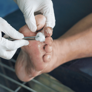 Debridement - Wound care