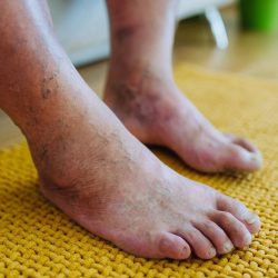 Laser Therapy For Diabetic Neuropathy