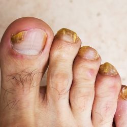 Laser Therapy For Toenail Fungus