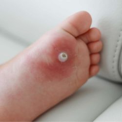 Swift Microwave For Plantar Warts