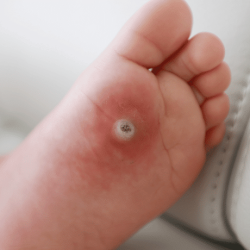 Plantar Warts - Restore Podiatry