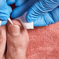 Toenail Fungus Treatment Options at Restore Podiatry